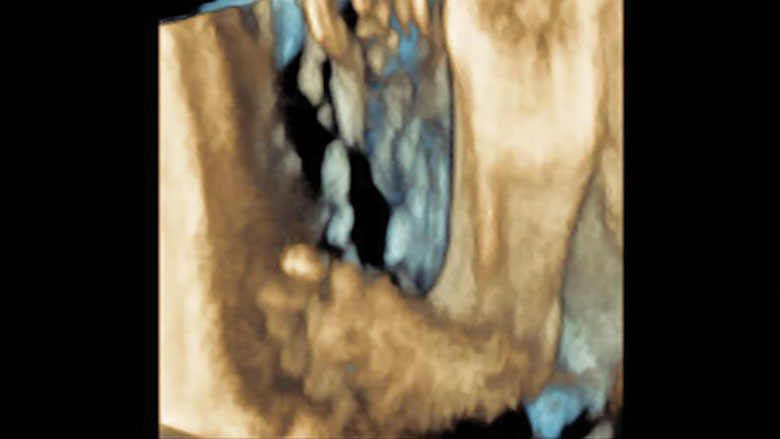 3-D ultrasounds of clubfoot