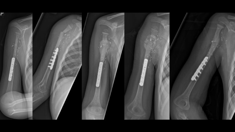 X-ray of Arkader Limb Tumor