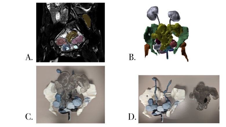 3D modeling process of a teenage girl's pelvic bone