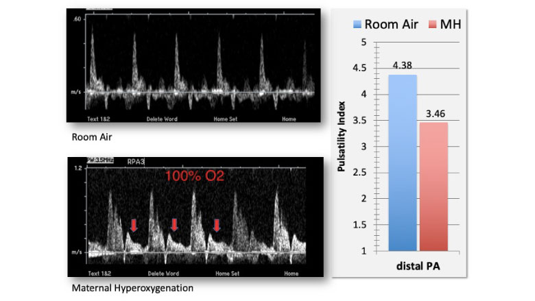 Doppler spectral display of blood flow in the right pulmonary artery under room air (top panel) and under conditions of 15 minutes of maternal hyperoxygenation (bottom panel).