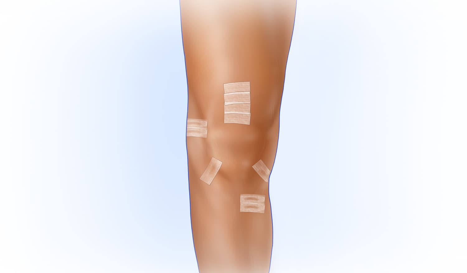 Fig. 1: Most ACL surgeries can be completed with five small incisions.