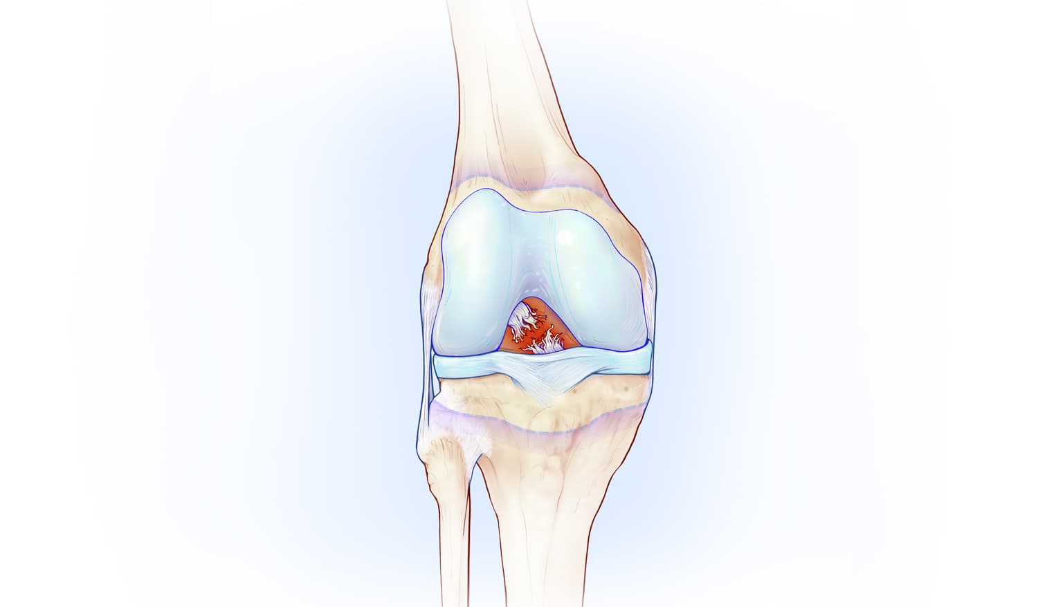 Fig. 2: Complete ACL tear