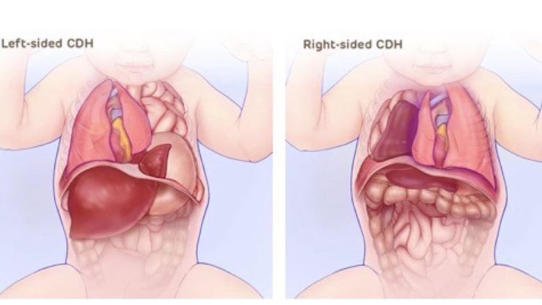 Mild-Congenital-Diaphragmatic-Hernia-Can-Hide-Until-After-Birth-CDH