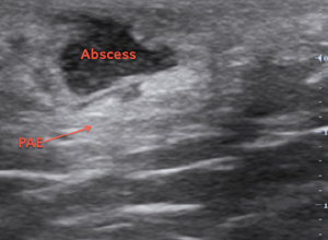 Abscess