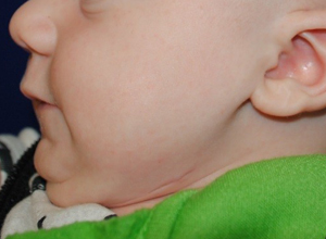 After MDO showing Mandibular Growth