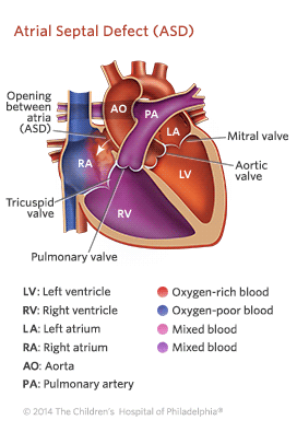 Atrial Septal Defect