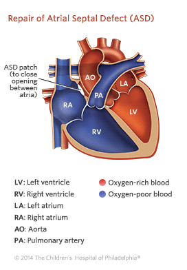 Atrial Septal Defect | Children's Hospital of Philadelphia Atrial Septal Defect | Children's Hospital of Philadelphia