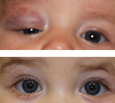 before and after infantile hemangioma