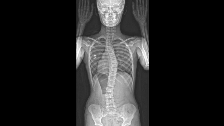 Scoliosis x-Ray showing positioning for bone age Scoliosis x-Ray showing positioning for bone age