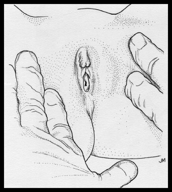 Illustration of Supine labial separation method