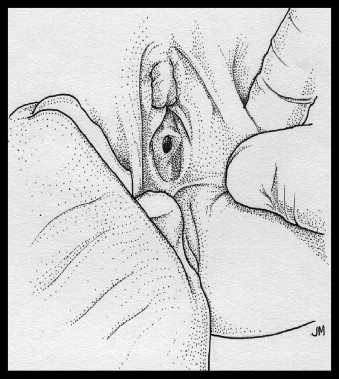 Illustration of Supine labial traction technique