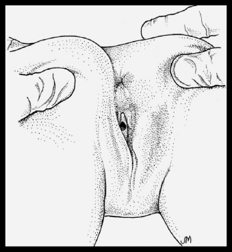 Illustration of Prone knee–chest position