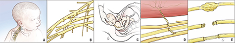 Brachial Plexus