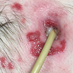 Candida fungal infection