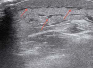 Abscess with Associated Cellulitis