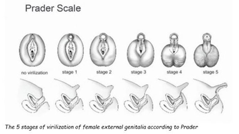 Prader Scale - Figure 1