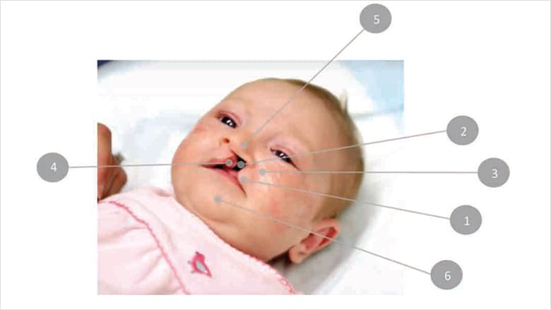 Cleft care chart