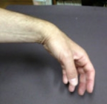 Wrist Drop (Radial Nerve injury)