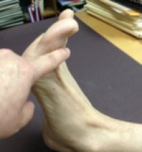 Dorsal web space between 1st and 2nd toes