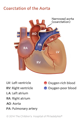 Coarctation of the Aorta Illustration