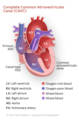 Complete Common Atrioventricular Canal Illustration