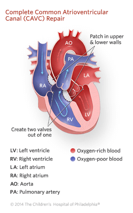 Complete Common Atrioventricular Canal Repair Illustration