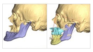Computer generated image of jaw surgery