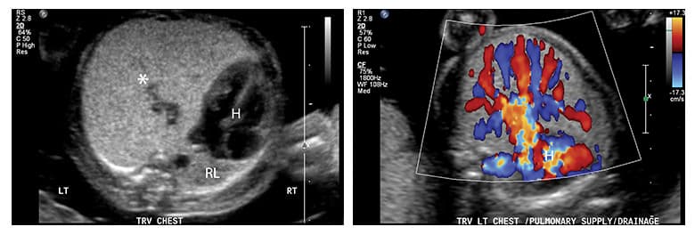 Congenital lobar overinflation ultrasound and MRI