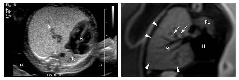 Congenital lobar overinflation ultrasound and MRI Congenital lobar overinflation ultrasound and MRI