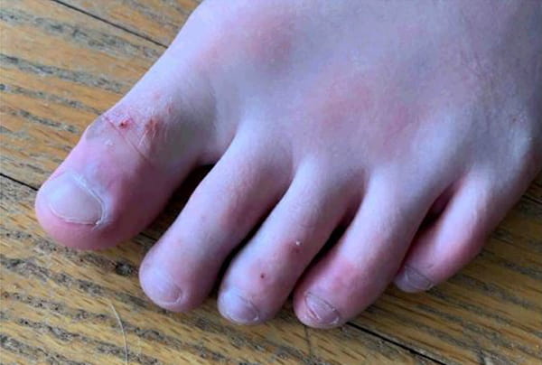 COVID Toes
