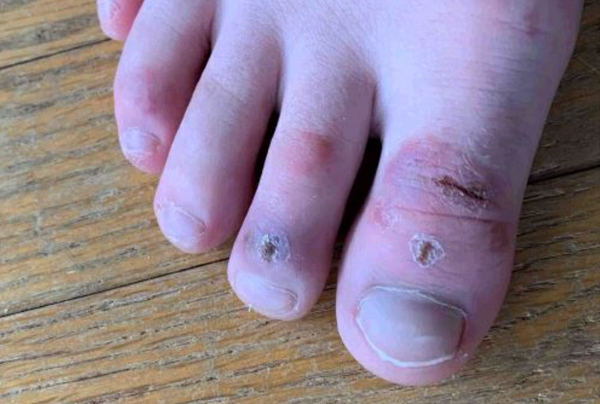 COVID Toes