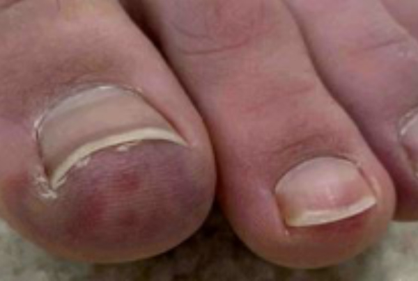 COVID Toes