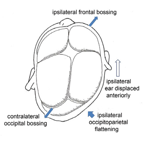 Deformational plagiocephaly illustration