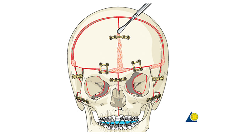 demonstration of facial bipartition