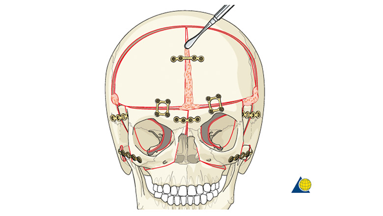 demonstration of four wall box osteotomy