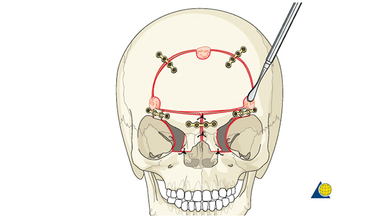 demonstration of medial orbital composite unit translocation