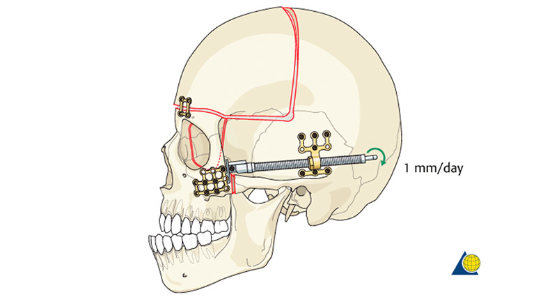 demonstration of Le Fort III and Monobloc advancement with Distraction Osteogenesis