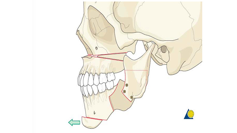 demonstration of Le Fort I advancement, bilateral sagittal split osteotomy (BSSO) and genioplasty
