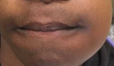 Diffuse Swelling. Dental Infection Example 1