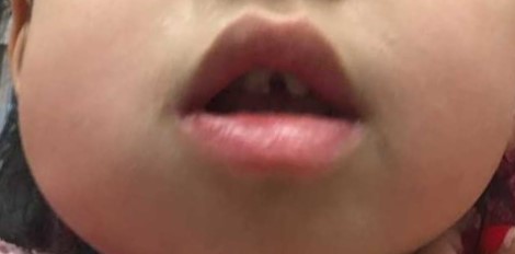 Diffuse Swelling. Dental Infection Example 2