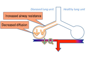 Diseased vs healthy lung unit with no iNO