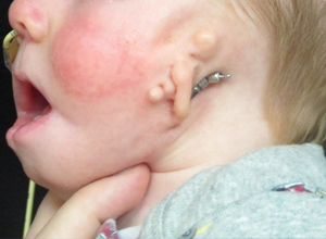 Distractor Arms behind the ear