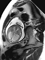 ultrafast fetal mri