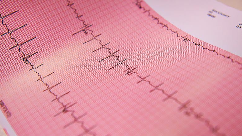 EKG results