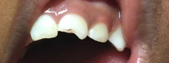 Ellis fracture, enamel. Example 1