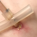 Mild Erythema