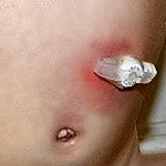 Moderate Erythema