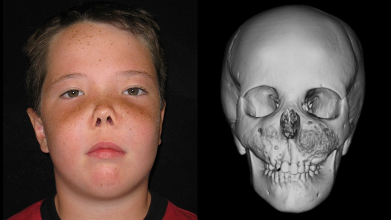 Patient with fibrous dysplasia