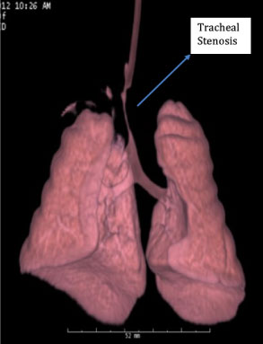 Long Segment Tracheal Stenosis Figure 7