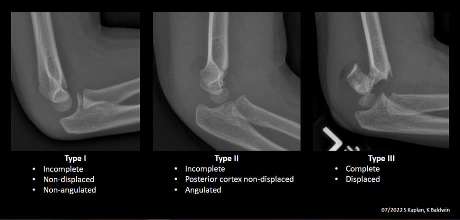 Three different X-rays of elbow fractures to describe type 1, 2, and 3 fractures